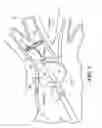 Fig. 08 - Real-time lesion formation assessment