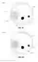 Fig. 03 - Radiofrequency ablation catheter with optical tissue evaluation