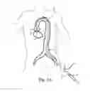 Fig. 02 - Transcatheter prosthetic heart valve delivery system and method with expandable stability tube