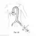 Fig. 03 - Transcatheter prosthetic heart valve delivery system and method with expandable stability tube