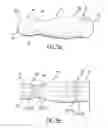 Fig. 06 - METHOD AND APPARATUS FOR STENTING