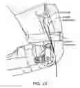 Fig. 22 - Orthopedic device including protruding members