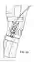 Fig. 23 - Orthopedic device including protruding members