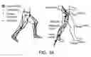 Fig. 33 - Orthopedic device including protruding members