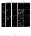 Fig. 20 - METHODS AND COMPOSITIONS FOR THE TREATMENT OF VASCULAR MALFORMATION