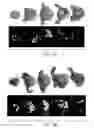 Fig. 04 - METHODS FOR PERFORMING A CORONARY ARTERY BYPASS GRAFT PROCEDURE
