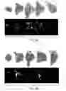 Fig. 05 - METHODS FOR PERFORMING A CORONARY ARTERY BYPASS GRAFT PROCEDURE