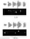 Fig. 06 - METHODS FOR PERFORMING A CORONARY ARTERY BYPASS GRAFT PROCEDURE