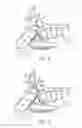 Fig. 08 - Sinus dilation catheter