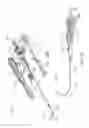 Fig. 12 - Sinus dilation catheter