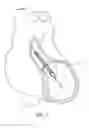 Fig. 04 - Catheter pump with off-set motor position