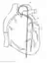 Fig. 01 - GUIDE CATHETER EXTENSION DEVICE AND METHODS OF USE FOR CARDIOLOGY PROCEDURES
