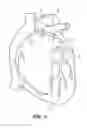 Fig. 04 - GUIDE CATHETER EXTENSION DEVICE AND METHODS OF USE FOR CARDIOLOGY PROCEDURES