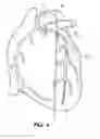 Fig. 05 - GUIDE CATHETER EXTENSION DEVICE AND METHODS OF USE FOR CARDIOLOGY PROCEDURES