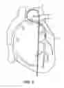 Fig. 06 - GUIDE CATHETER EXTENSION DEVICE AND METHODS OF USE FOR CARDIOLOGY PROCEDURES