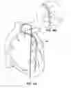 Fig. 07 - GUIDE CATHETER EXTENSION DEVICE AND METHODS OF USE FOR CARDIOLOGY PROCEDURES