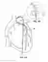 Fig. 09 - GUIDE CATHETER EXTENSION DEVICE AND METHODS OF USE FOR CARDIOLOGY PROCEDURES