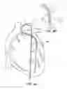 Fig. 10 - GUIDE CATHETER EXTENSION DEVICE AND METHODS OF USE FOR CARDIOLOGY PROCEDURES