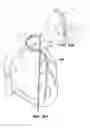 Fig. 11 - GUIDE CATHETER EXTENSION DEVICE AND METHODS OF USE FOR CARDIOLOGY PROCEDURES