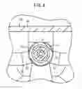 Fig. 05 - Catheter assembly