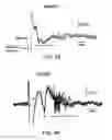 Fig. 09 - Dipole electrical stimulation employing direct current for recovery from spinal cord injury