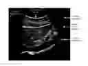 Fig. 01 - Ultrasound focal zone system and method