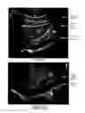 Fig. 03 - Ultrasound focal zone system and method