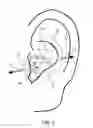 Fig. 04 - Integration of sensors into earphones