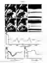 Fig. 07 - Non-cartesian retrospective reconstruction of cardiac motion in patients with severe arrhythmia