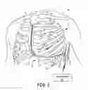 Fig. 02 - Determining paced cardiac depolarization waveform morphological templates