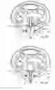 Fig. 12 - Device for reducing the retraction of a fascia or a soft tissue mantle in an open soft tissue defect