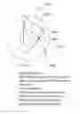 Fig. 30 - Auxiliary apparatus for minimally invasive surgery and method to use the same