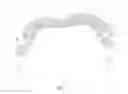 Fig. 17 - System for intra-abdominally moving an organ