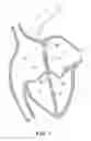 Fig. 02 - Heart occlusion devices