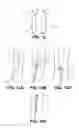 Fig. 07 - Systems and methods for endoluminal valve creation