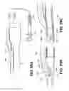 Fig. 41 - Systems and methods for endoluminal valve creation