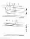 Fig. 44 - Systems and methods for endoluminal valve creation