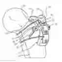 Fig. 01 - Periprosthetic plating system including plate with system for retaining tension on a cable