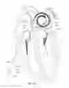 Fig. 26 - Enhanced medical device for use in bodily cavities, for example an atrium
