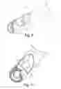 Fig. 06 - Endoscopic vessel harvester with blunt and active dissection