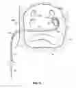 Fig. 07 - Systems and methods for treating the heart with ablation