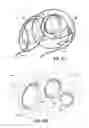 Fig. 12 - Systems and methods for treating the heart with ablation