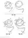 Fig. 13 - Systems and methods for treating the heart with ablation