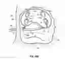 Fig. 28 - Systems and methods for treating the heart with ablation