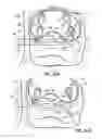 Fig. 42 - Systems and methods for treating the heart with ablation