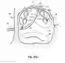 Fig. 47 - Systems and methods for treating the heart with ablation