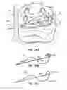 Fig. 48 - Systems and methods for treating the heart with ablation