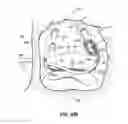 Fig. 62 - Systems and methods for treating the heart with ablation