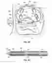 Fig. 64 - Systems and methods for treating the heart with ablation
