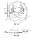 Fig. 72 - Systems and methods for treating the heart with ablation